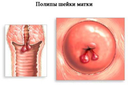 Полипы шейки матки