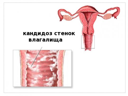 Особенности выпадения матки и влагалища