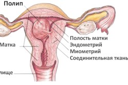 Схема полипа эндометрия