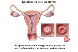 Конизация - причина укорочения шейки матки