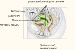 Cимптомы и лечение наружного эндометриоза