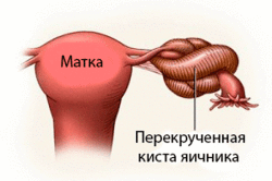Перекручивание кисты яичника - показание к лапароскопии
