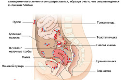 Места распространения эндометриоза