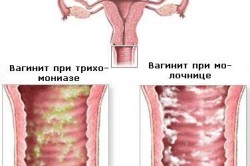 Разновидности вагинита