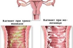 Вагинит Вагинит