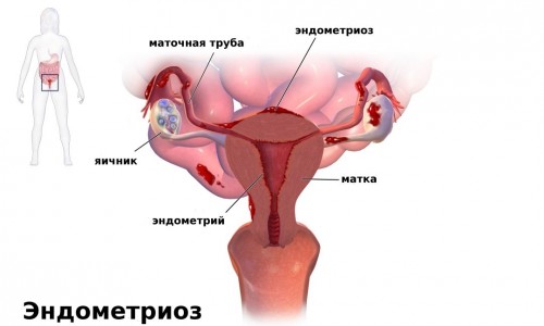 Как правильно лечить эндометриоз матки народными средствами?