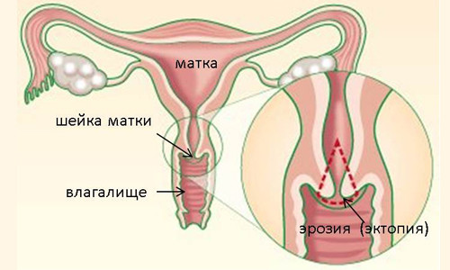 Что означают выделения после прижигания эрозии?