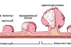 Схема расположения полипа матки