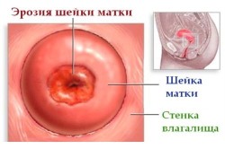 Эрозия шейки матки