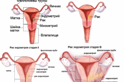 Рак эндометрия - следствие гиперплазии Рак эндометрия - следствие гиперплазии
