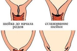 Этапы размягчения шейки матки