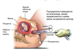 Выскабливание матки до 12 недель