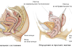Выпадение матки: признаки и лечение