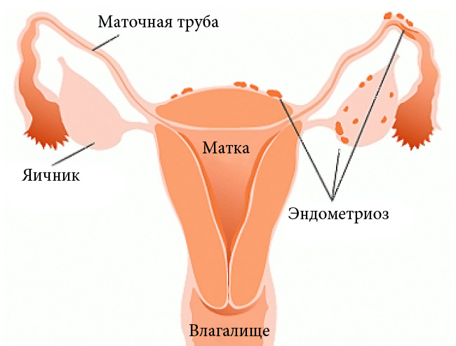 Чем лечить эндометриоз какими лекарственными препаратами?