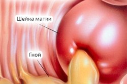 Гонорея как причина коричневых выделений при менструации
