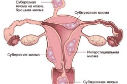 Виды миом матки