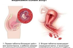 Принцип медикаментозного аборта