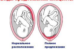 Предлежание плаценты - причина кровянистых выделений при беременности