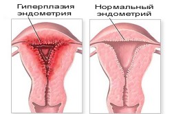 Схема гиперплазии эндометрия Схема гиперплазии эндометрия