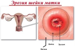 Проведение криодеструкции шейки матки