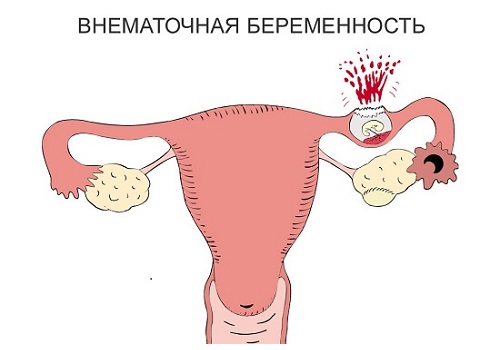Внематочная беременность - причина светло коричневых выделений