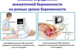 Способы определения внематочной беременности