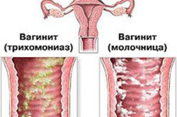 Причины симптомы и лечение острого вагинита