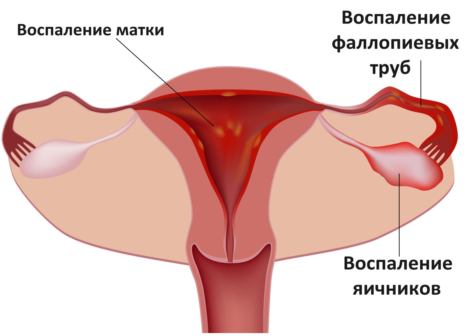 В каких случаях после прижигания эрозии кровит?