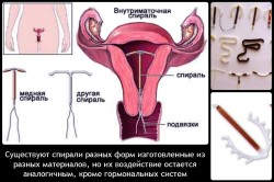 Почему могут возникнуть выделения после установки внутриматочной спирали?