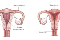 Эндометрит и аднексит - причины выделений