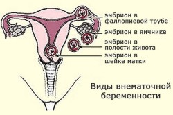 Внематочная беременность