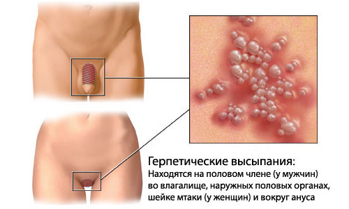 Герпетические высыпания