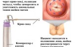 Суть криодеструкции шейки матки