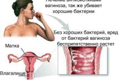 Бактериальный вагиноз - причина выделений зеленоватого цвета