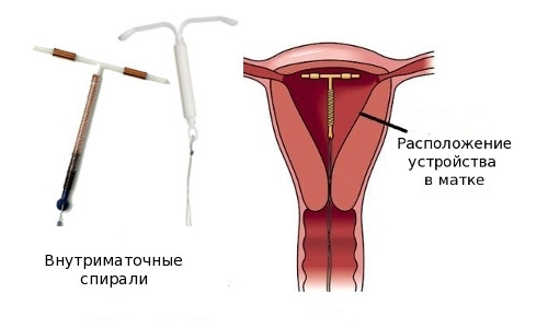 Установка внутриматочной спирали после родов