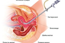 Принцип гистероскопии 