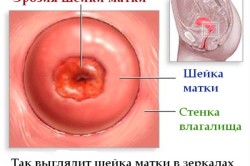 Опасна ли эрозия после родов?