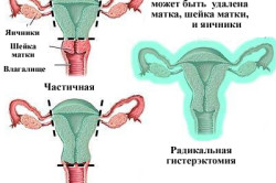 Типы гистерэктомии матки