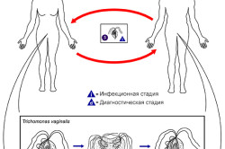 Развитие трихомониаза