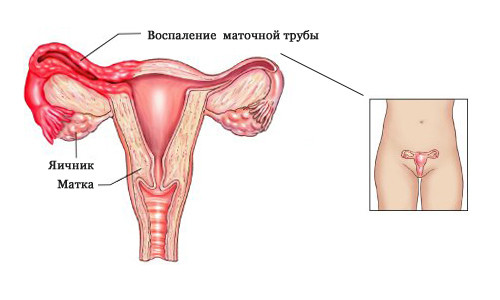 Причины и лечение воспаления придатков