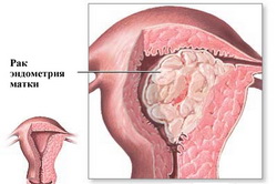 Рак эндометрия матки