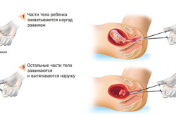 Хирургический аборт