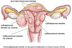 Схема субсерозной миомы матки