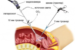 Схема лапароскопии