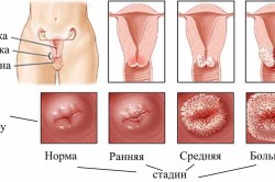 Прогрессирование эрозии шейки матки