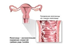 Вагинальная молочница у женщин Вагинальная молочница у женщин