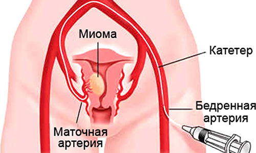 Эффективное лечение миомы матки небольших размеров