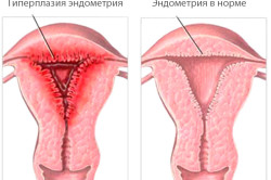 Как происходит лечение железистой гиперплазии эндометрия народными средствами?