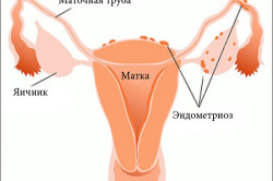 Внутренний эндометриоз матки